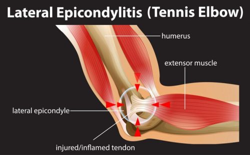 lateral-epicondylitis-tennis-elbow_1308-47127