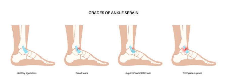 sprained-ankle-injury-vector-47869828
