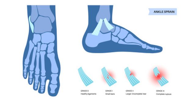sprained-ankle-injury-vector-47869831