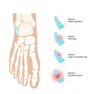 sprained-ankle-injury-vector-47976608